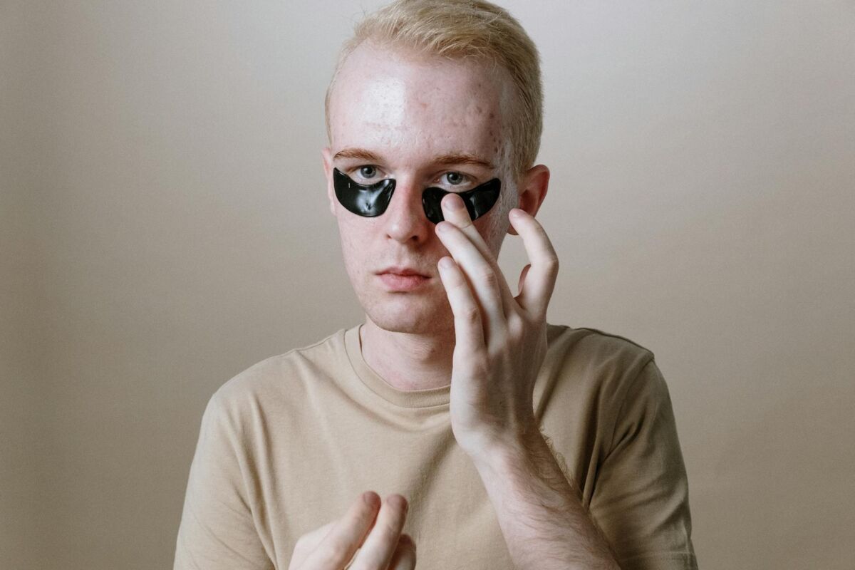 Aknės randai ir jų prevencija: ką daryti kol dar ne vėlu